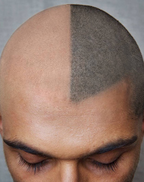 This Hair Tattoo Artist Is Inking Bald Peoples Heads to Fight Hair Loss